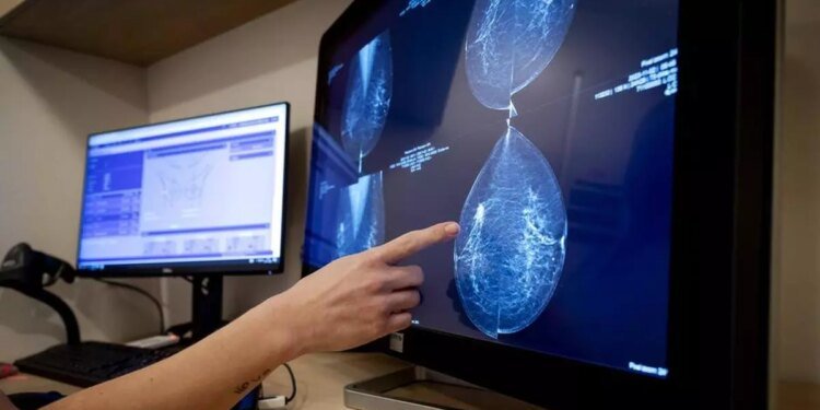New AI Method May Help In Early Breast Cancer Detection