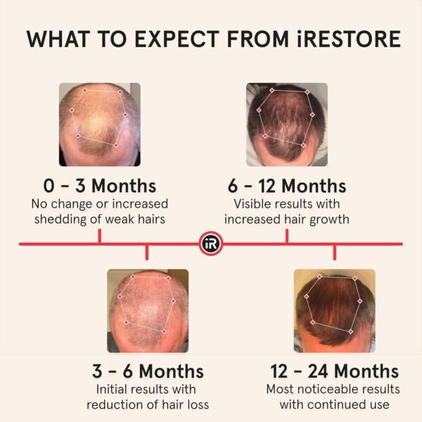 🌿 iRestore Professional Laser Red Light Therapy for Hair Growth System - FDA Cleared Hair Loss, Hair Thinning & Alopecia Treatment for Men & Women - 282 Lasers & LEDs – Immunity, Bone & Wellness Support - Image 5