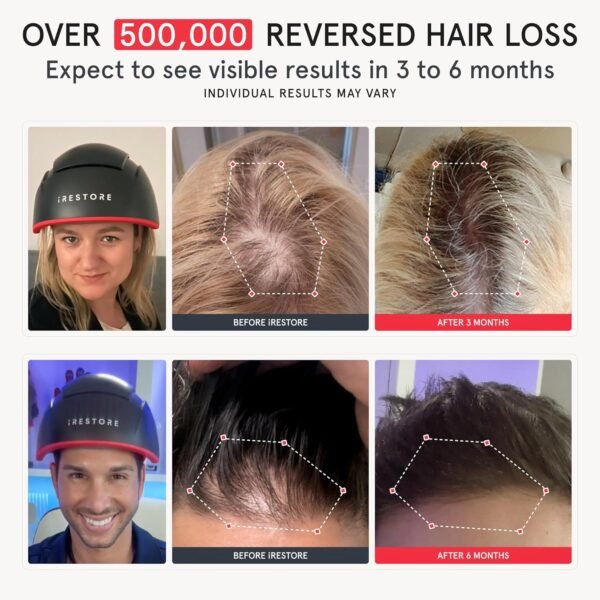 iRestore Elite - Laser Red Light Therapy for Hair Growth System - FDA Cleared Hair Loss, Hair Thinning & Alopecia Treatment for Men & Women - Laser Cap for Hair Regrowth Stimulates Denser Fuller Hair - Image 2