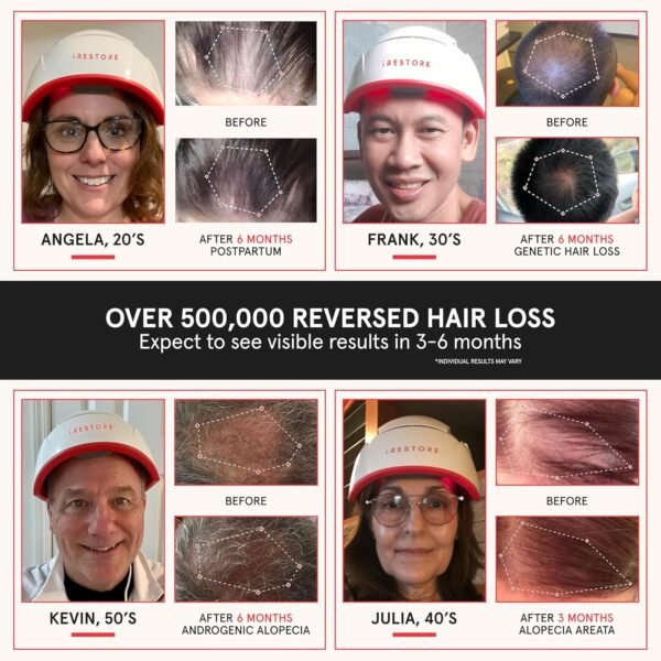 🌿 iRestore Professional Laser Red Light Therapy for Hair Growth System - FDA Cleared Hair Loss, Hair Thinning & Alopecia Treatment for Men & Women - 282 Lasers & LEDs – Immunity, Bone & Wellness Support - Image 2